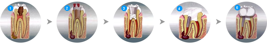 根管治療過(guò)程