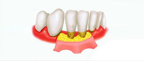 中重度牙周病方案翻瓣手術(shù) 